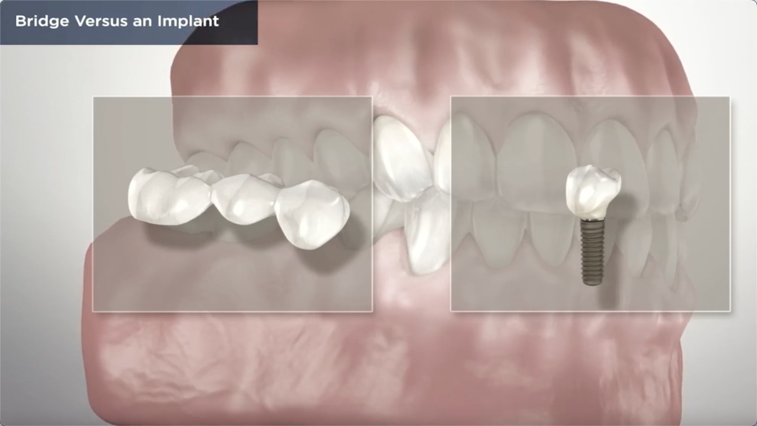 Dental Bridge Vs. Dental Implant