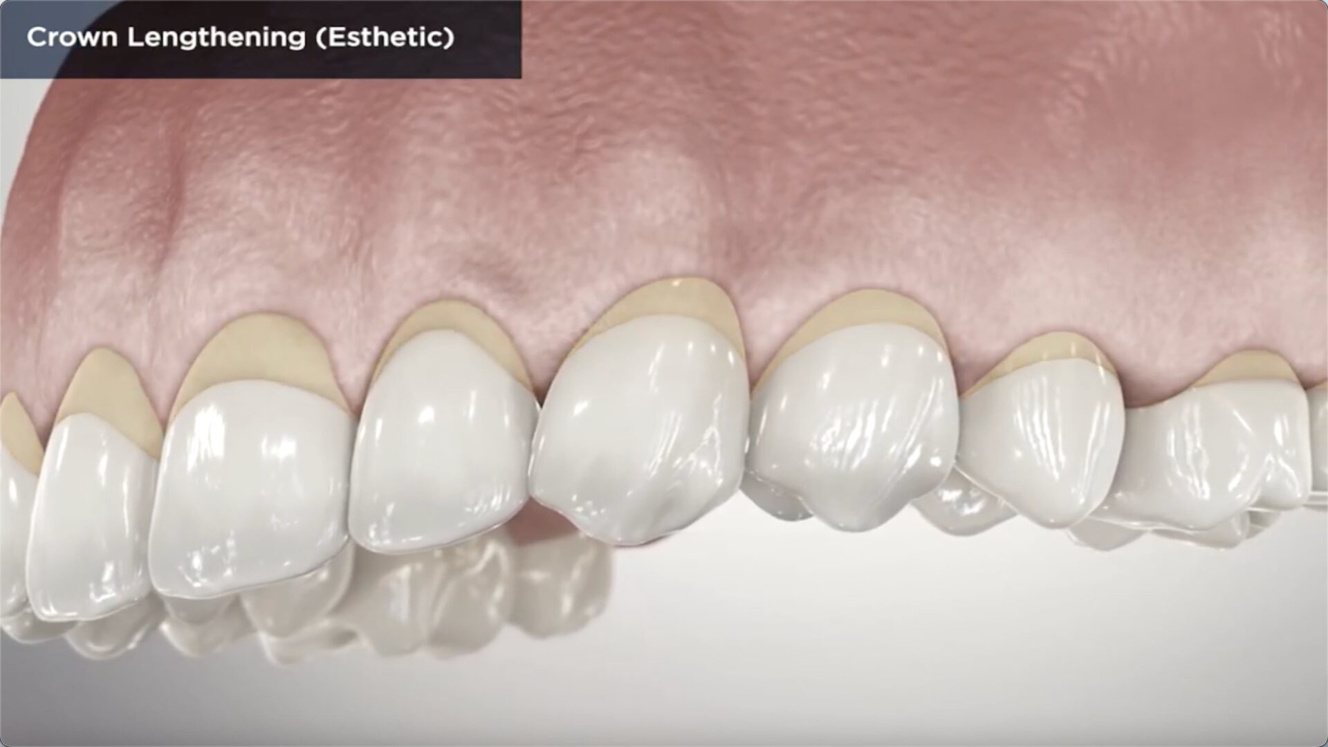 Dental Crown Lengthening