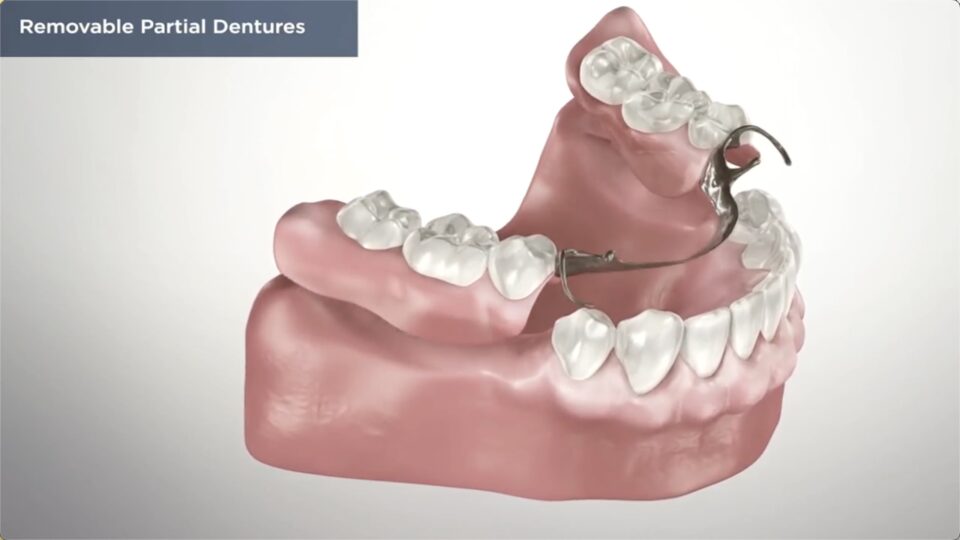 Removable Partial Dentures Vancouver WA