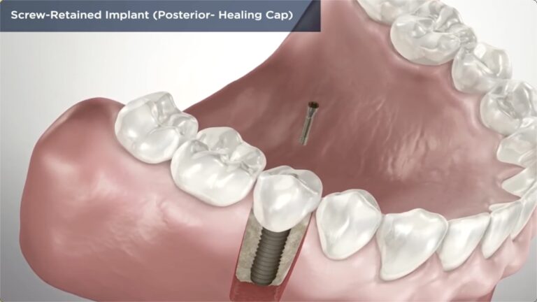 Dental Implant Near Me