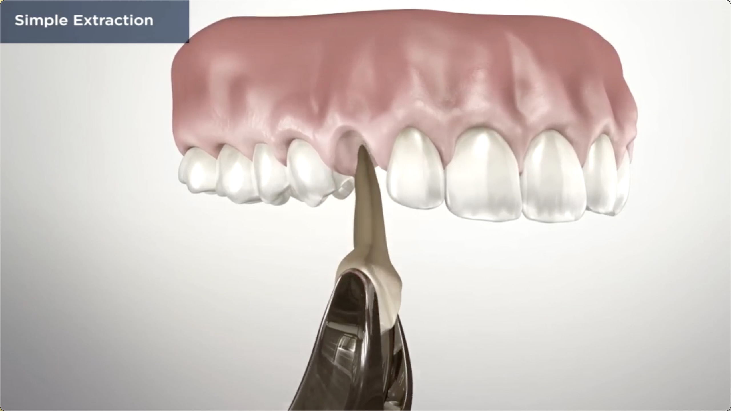 How Much Does a Tooth Extraction Cost in Vancouver?