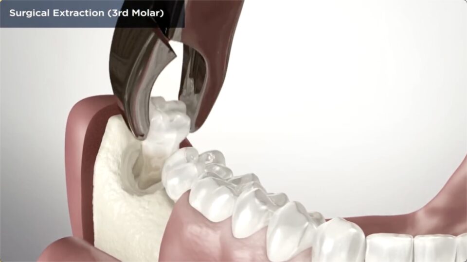 Dental Extraction In Vancouver Wa