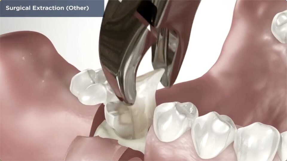 Tooth Extraction Vancouver WA