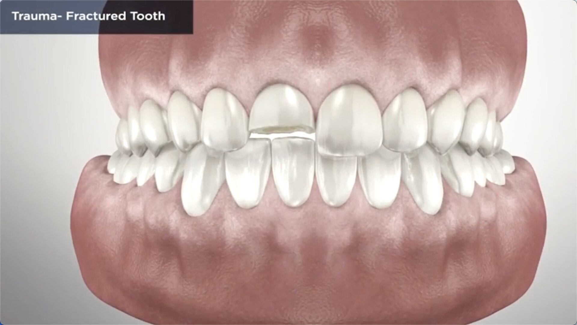 Tooth Rupture Emergency Dentistry in Vancouver, WA | Cascade Dental