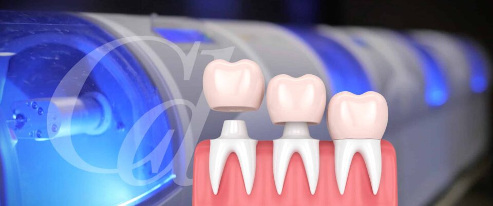 Same Day Dental Crowns In Vancouver Wa