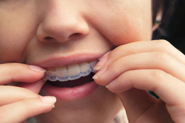 clear aligners Vancouver WA