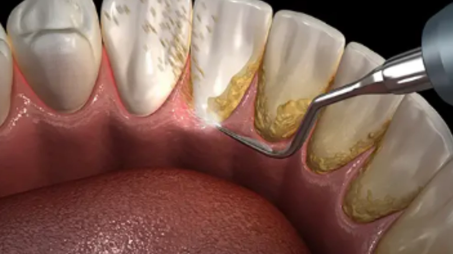 combat swollen gums tailored periodontal treatments for gum health