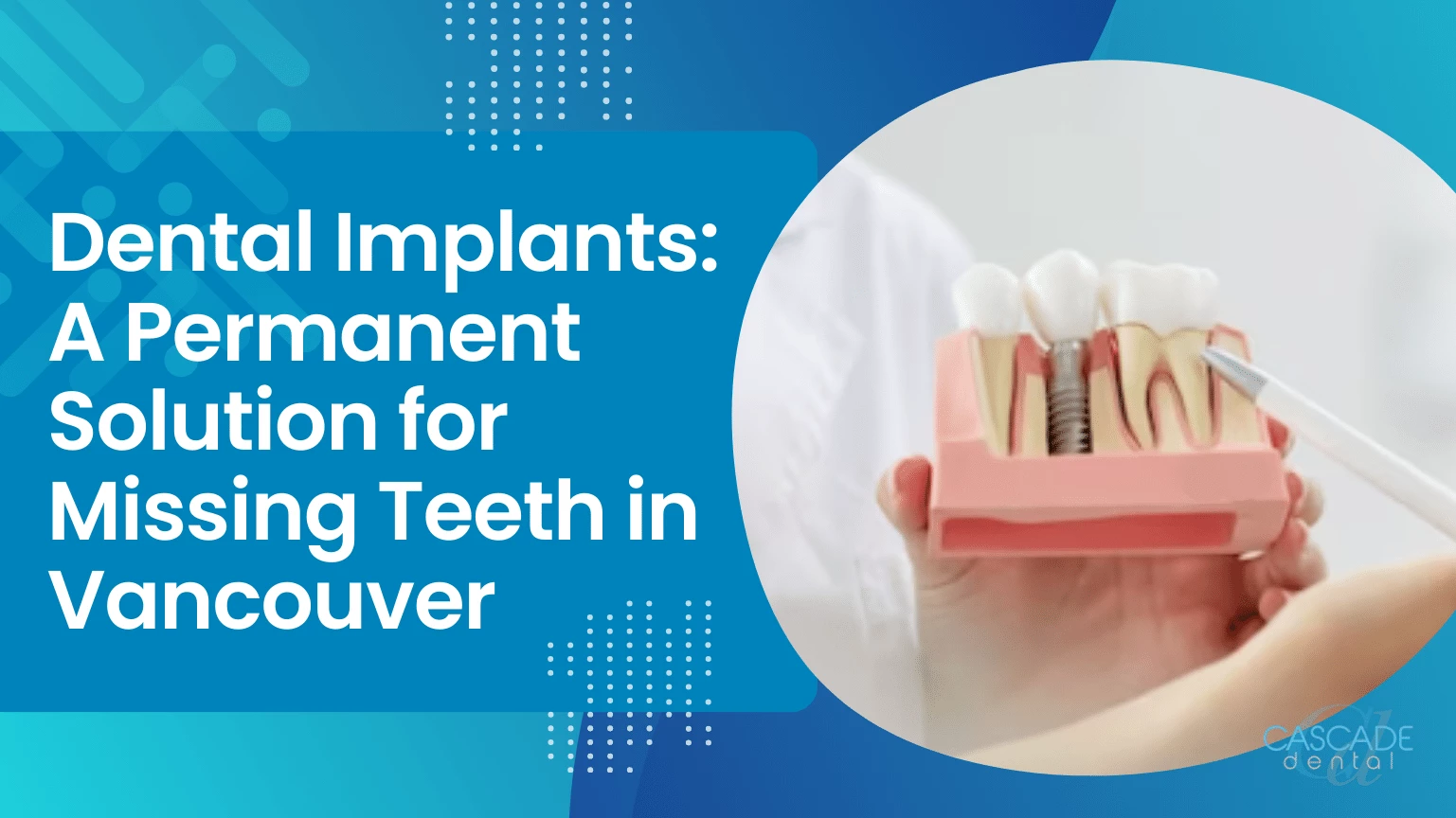 dental implants a permanent solution for missing teeth in vancouver