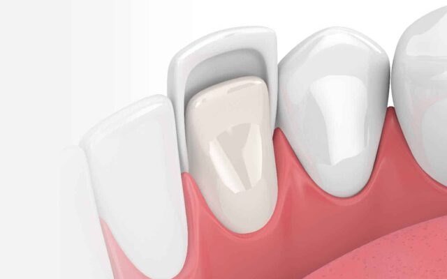 Dental Veneers