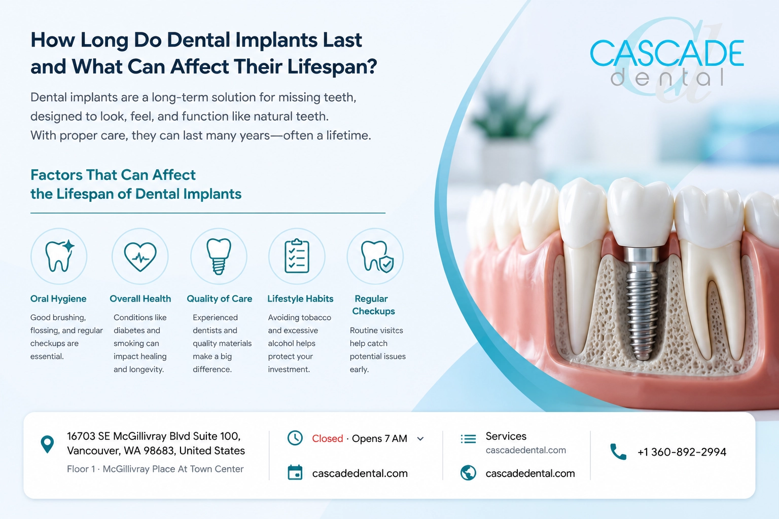 Dental Implant Infographic Dental Implant Infographic