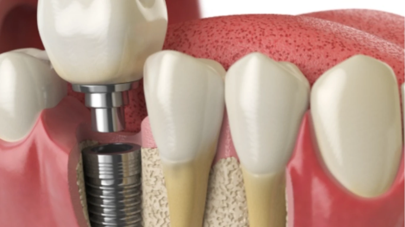 how long do dental implants last your dentist explains