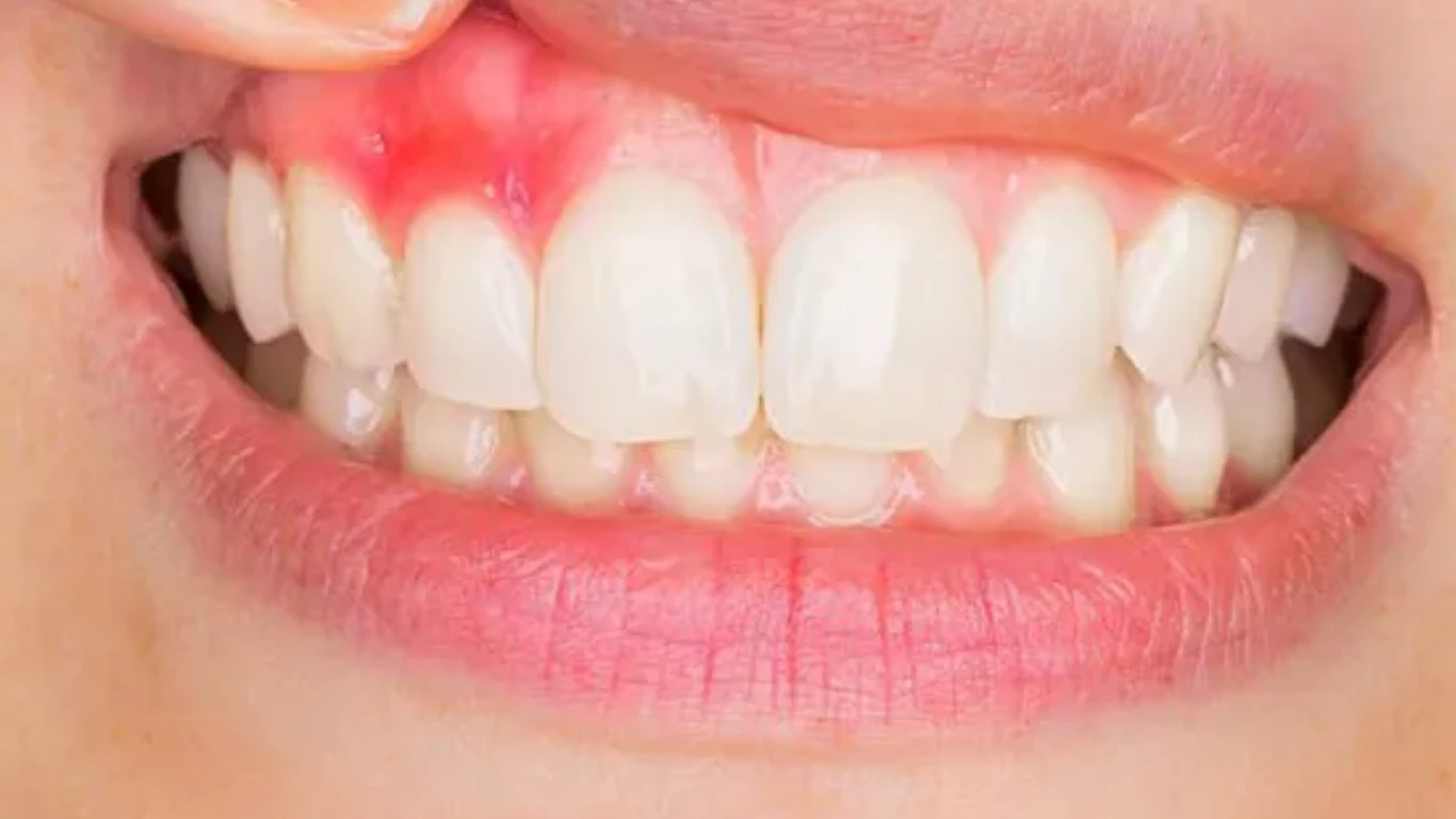 say goodbye to hard lumps dental veneers & swollen gums