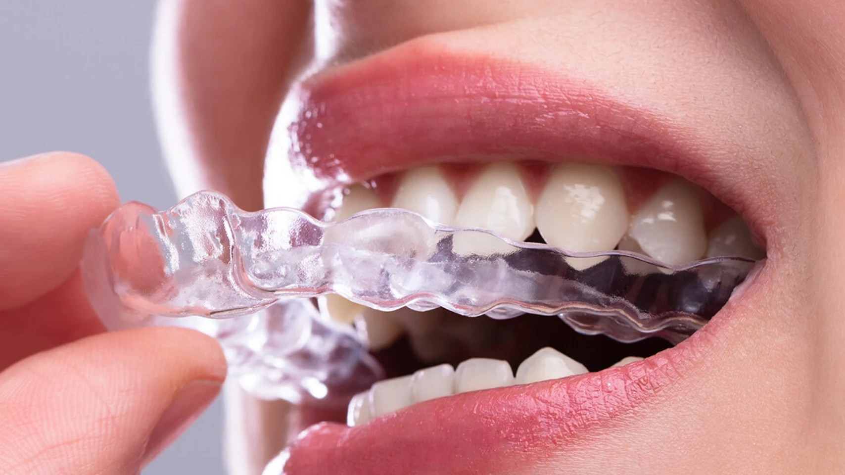 suresmile aligners straighten teeth, soothe tooth pain